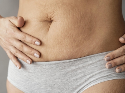 Routine anti-vergetures : hydrater sa peau pendant et après la grossesse
