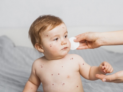 Varicelle chez bébé, que faire ?